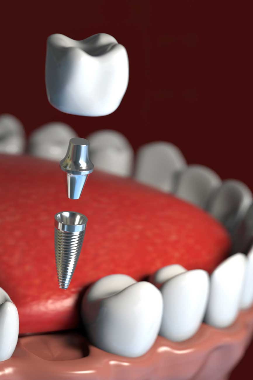 implantes dentales en Viladecans, implantología oral en Viladecans