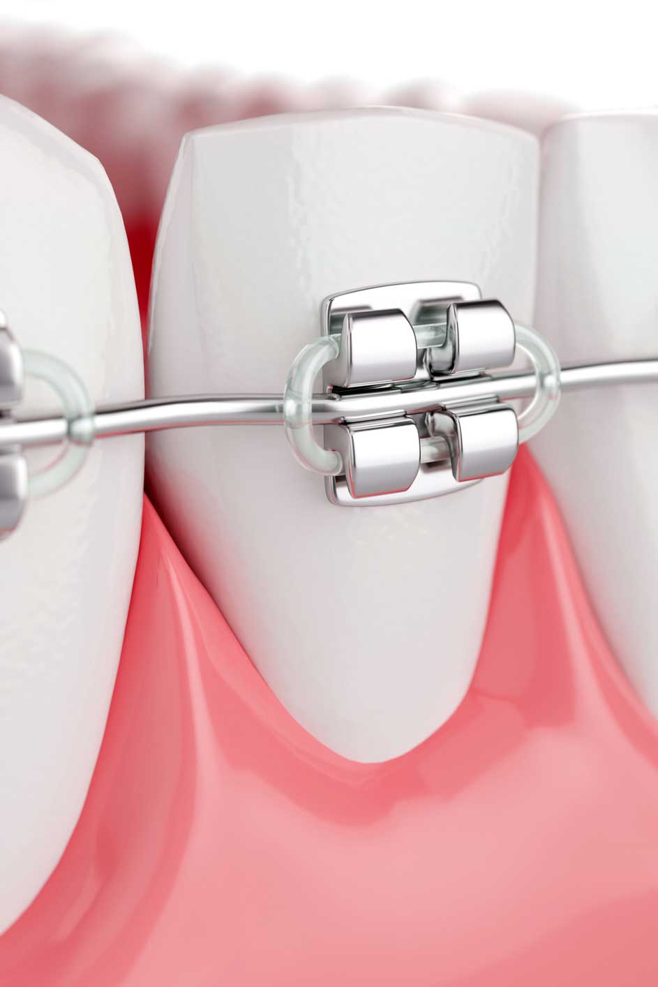 ortodoncia con brackets en Viladecans, brackets metálicos en Viladecans, ortodoncistas en Viladecans.